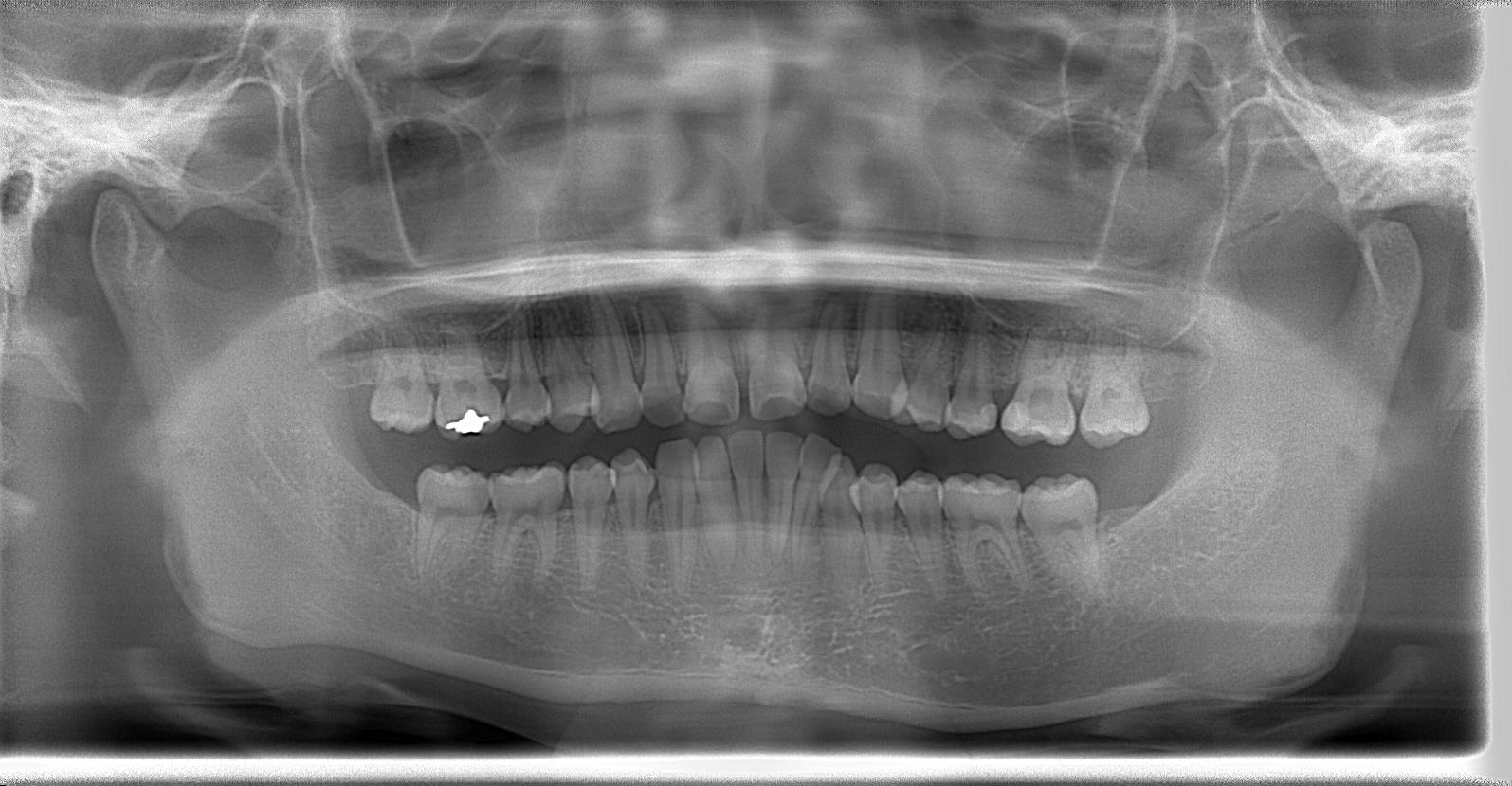 術前パノラマレントゲン写真