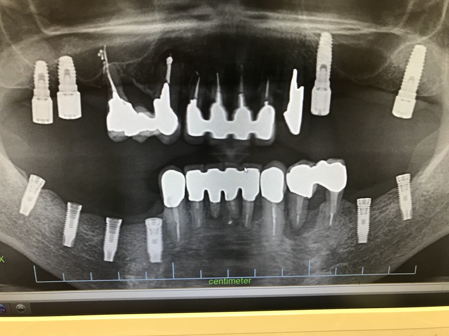 インプラント① 術後