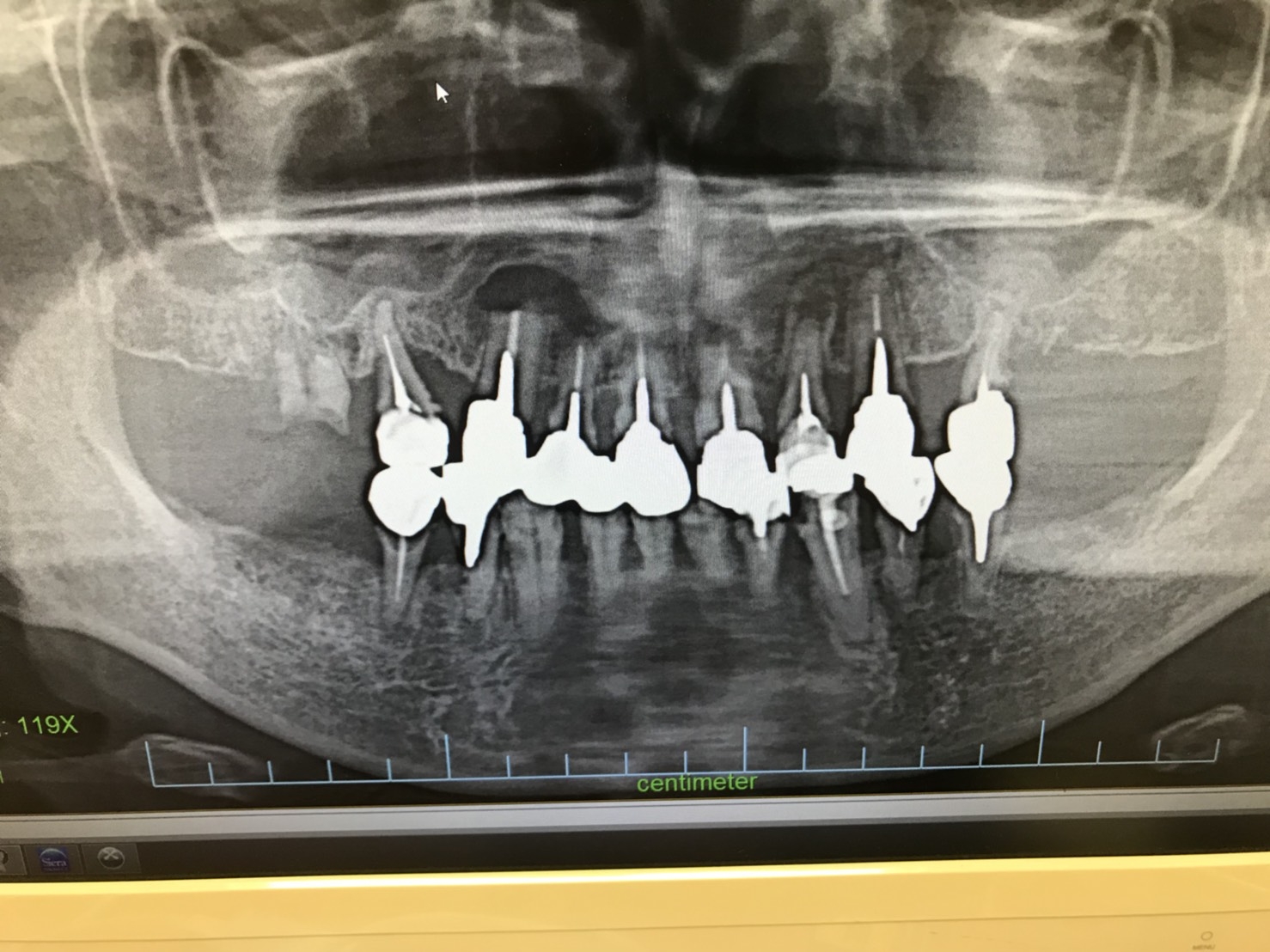 インプラント① 術前