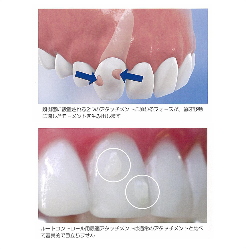 歯根移動のコントロールがさらに向上