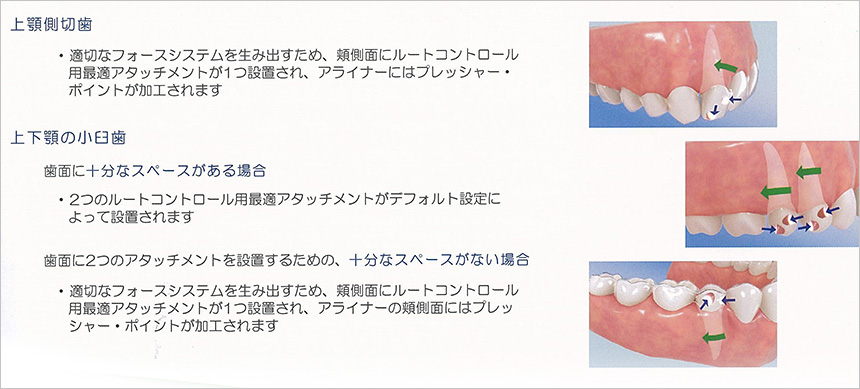 ルートコントロール用最適アタッチメントの適用範囲がさらに拡大