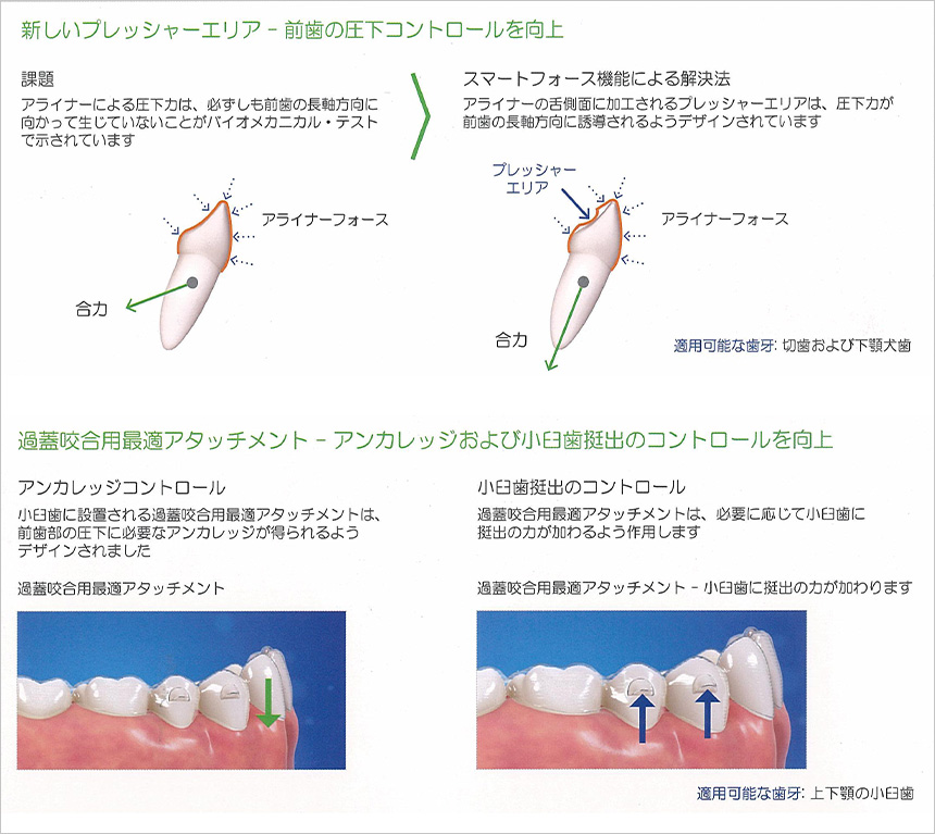 より予測実現性の高い過蓋咬合治療